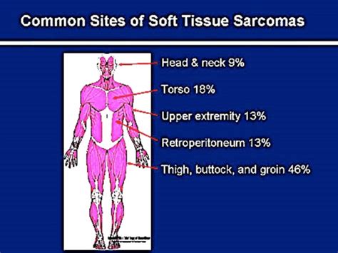 the lump tested as soft tissue hemangiosarcoma|What to know about pediatric soft tissue sarcoma.